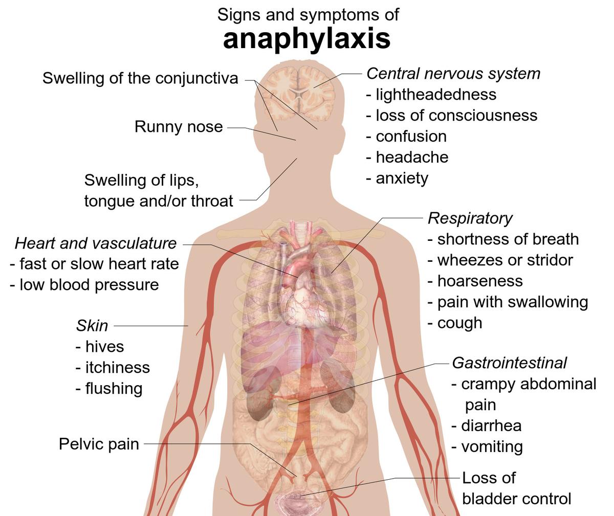 How your immune system reacts through anaphylactic shocks to protect you from the “invaders” How your immune system reacts through anaphylactic shocks to protect you from the “invaders”